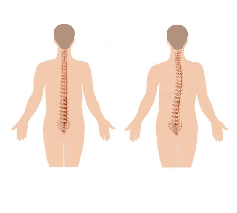 colonna vertebrale sana e malata