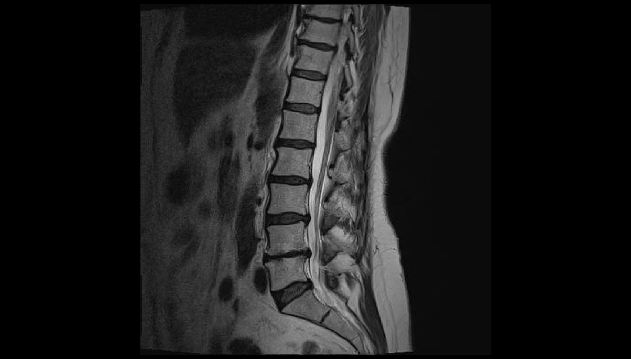 diagnosi di mal di schiena nella regione lombare