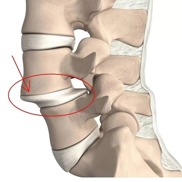 lesioni vertebrali