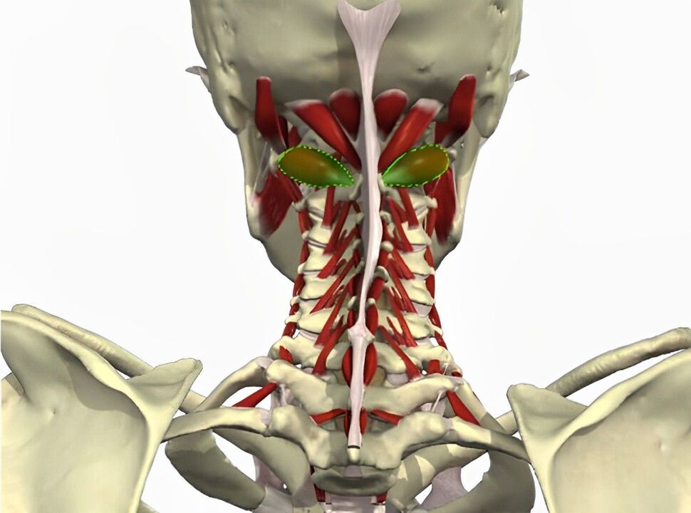 sindrome dell'arteria vertebrale