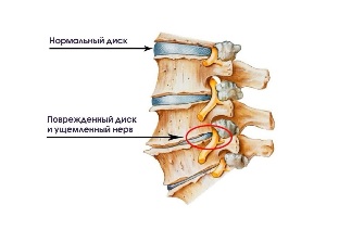 I sintomi di artrosi cervicale