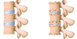 come riconoscere la presenza di osteocondrosi della colonna lombare