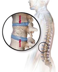 L'osteoporosi provoca mal di schiena nella regione lombare